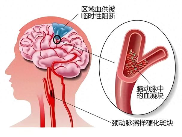 临沂治脑梗哪家医院好