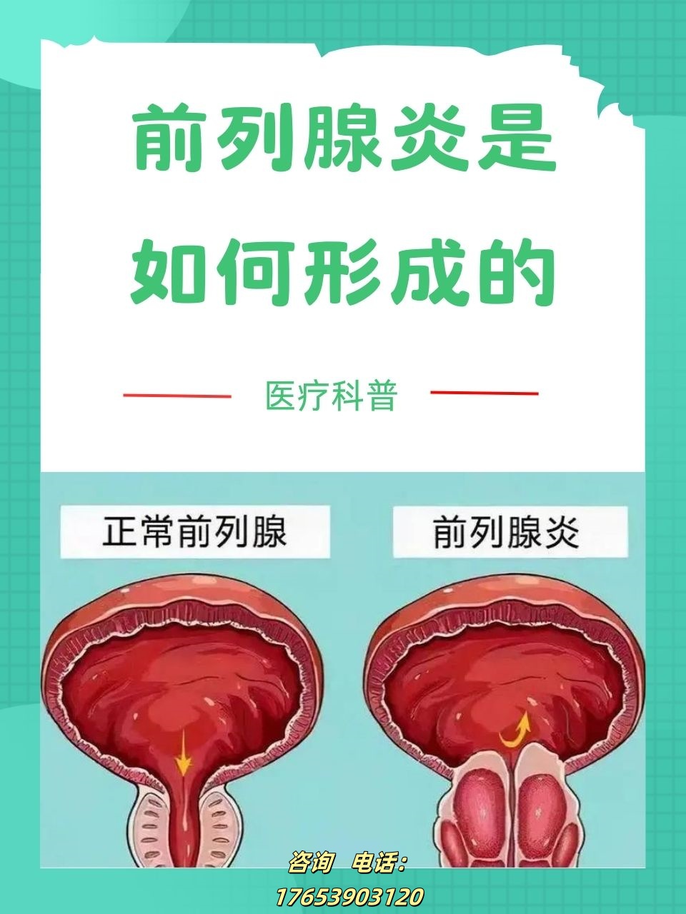 前列腺炎的病因及临沂永辉医院的有效治疗