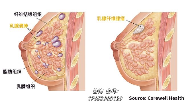 临沂永辉医院：中医中药治疗乳腺结节的优势与病因详解