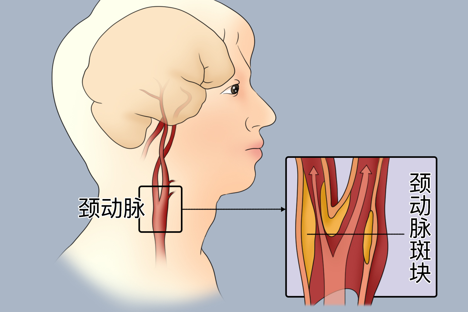 临沂永辉医院：中西医联手，破解颈动脉斑块难题