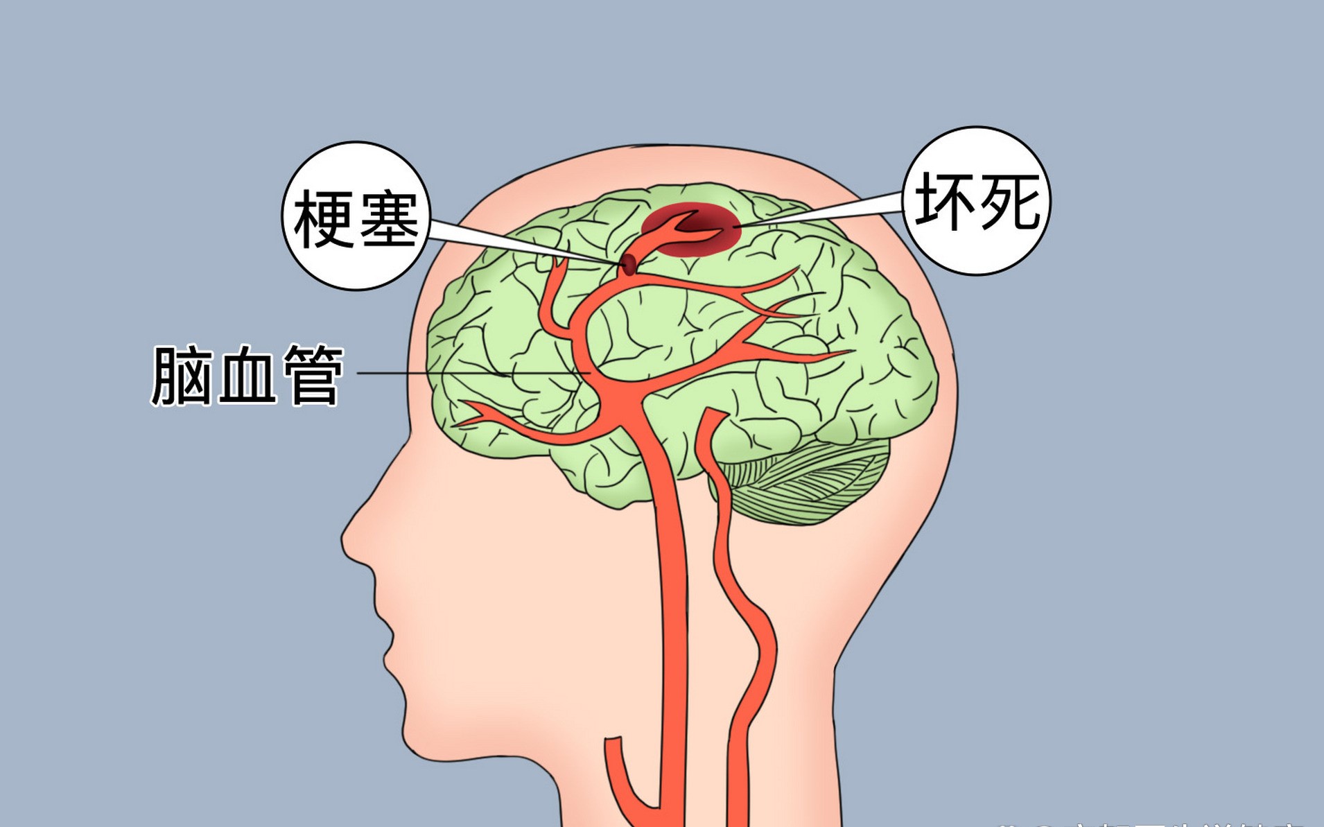 临沂永辉医院：脑梗治疗的专业之选