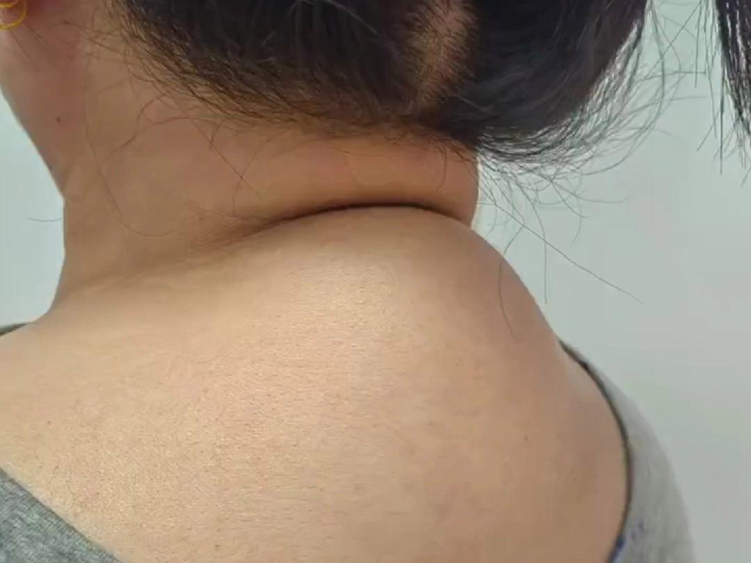 长了富贵包怎么样才能消除？