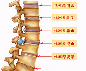 腰椎间盘突出是怎么形成的,临沂治腰椎间盘哪里好？