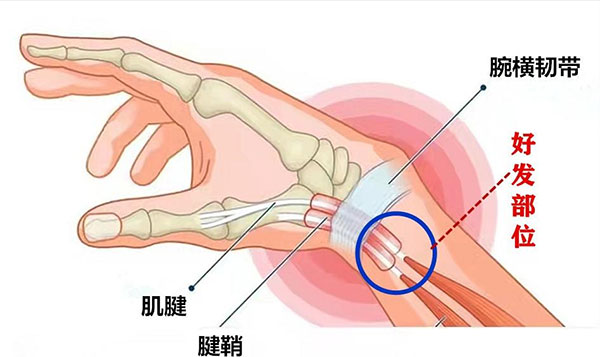 临沂治腱鞘炎,小针刀治腱鞘炎